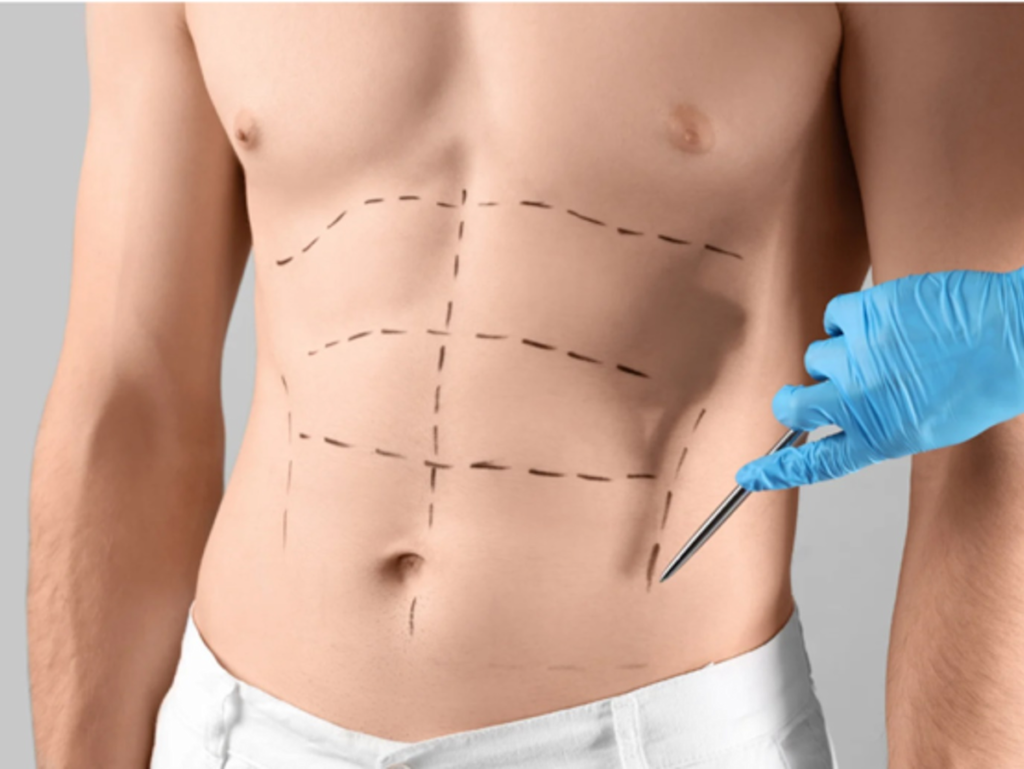 How Safe Is Abdominoplasty in Islamabad?