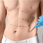 How Safe Is Abdominoplasty in Islamabad?