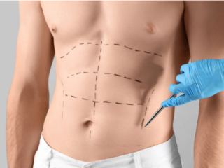 How Safe Is Abdominoplasty in Islamabad?